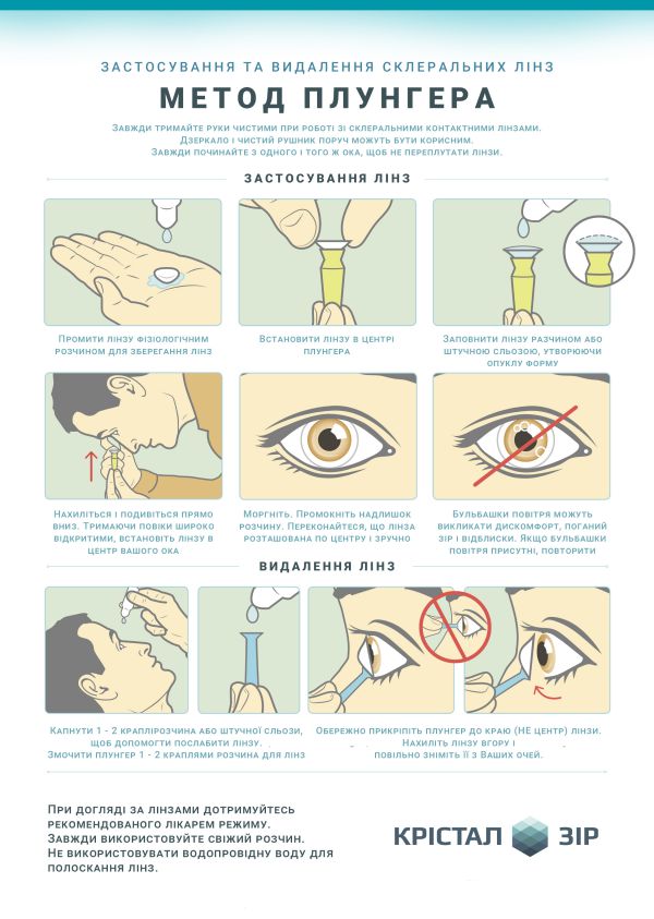Застосування та видалення склеральних лінз (рис. 2)